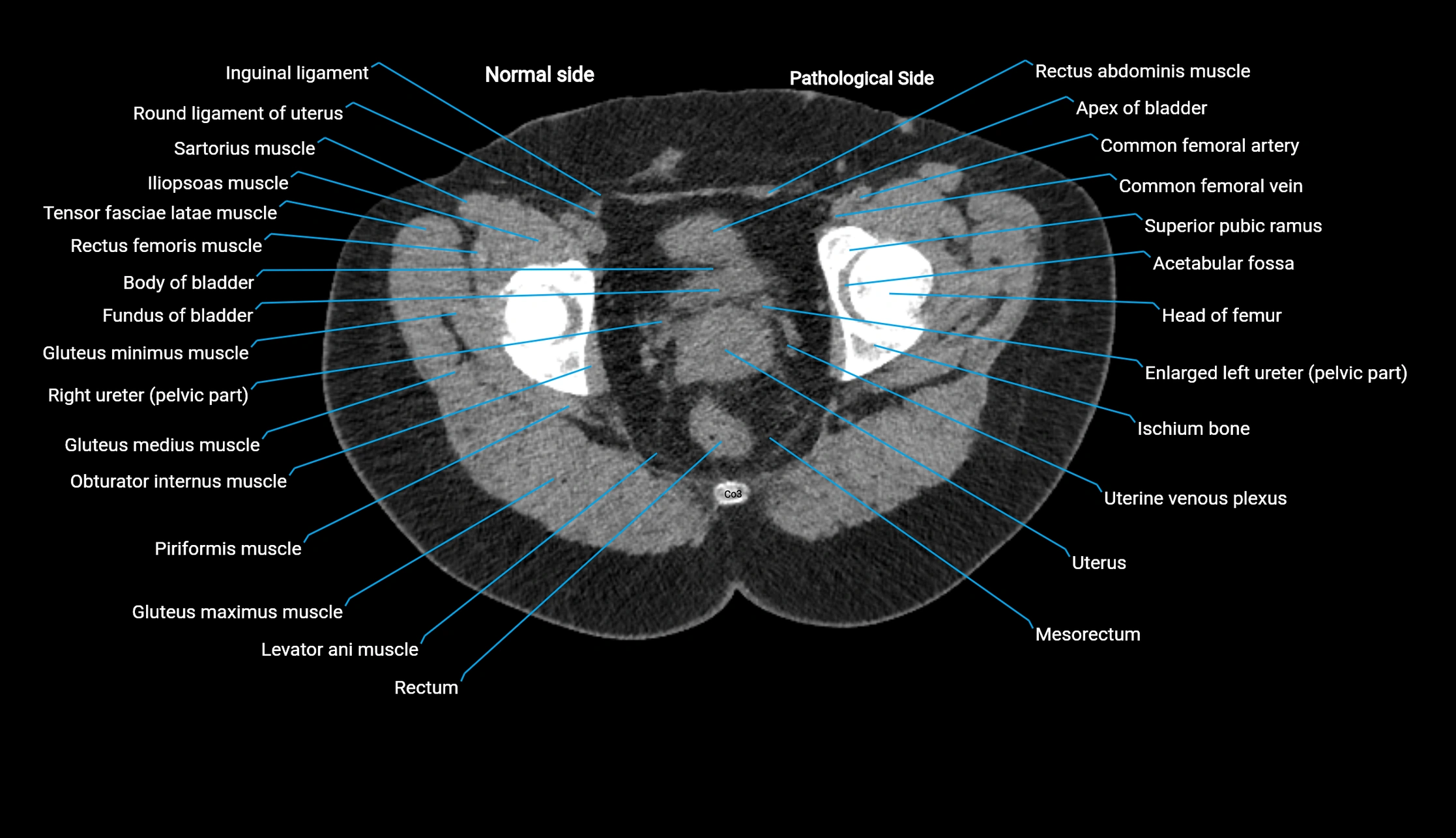 CT KUB axial cross sectional anatomy  radiology image -img-00201-00156.webp